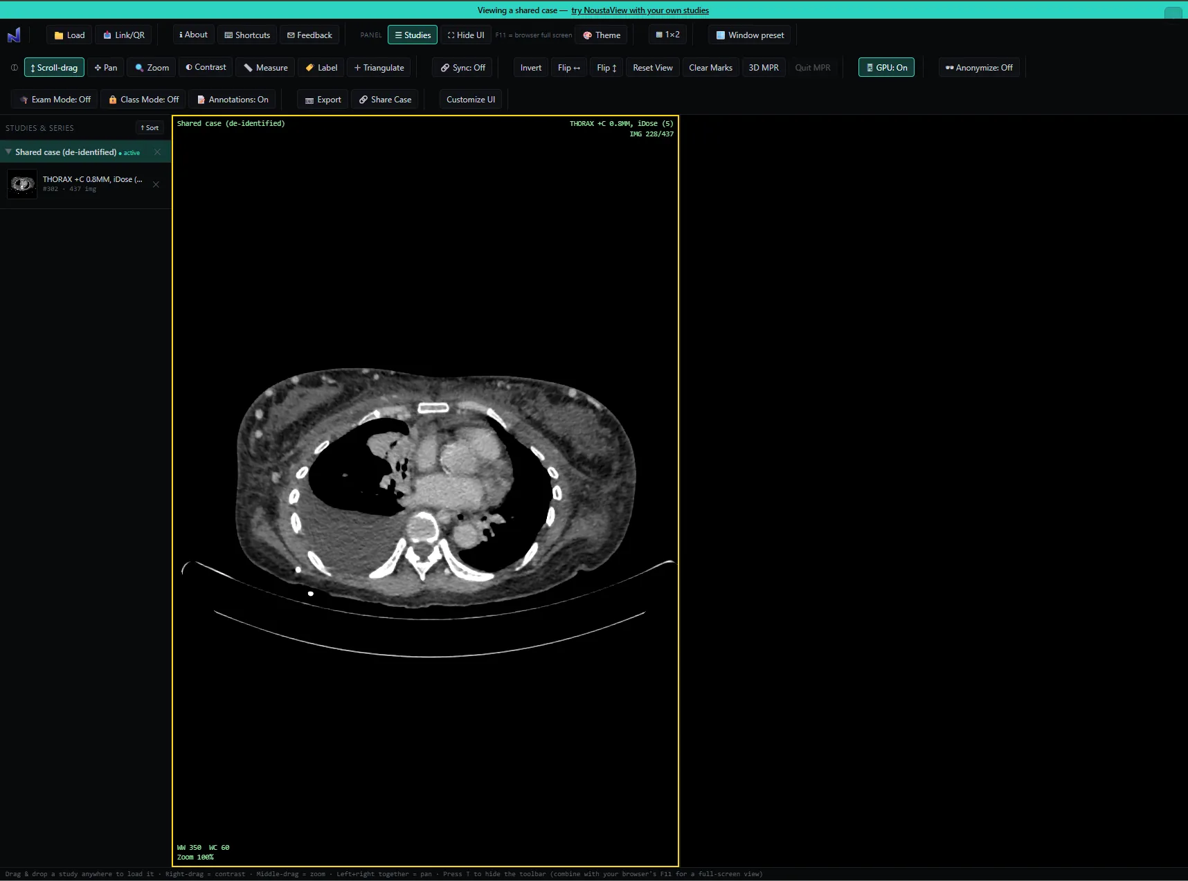 NoustaView on desktop, showing the complete toolbar while viewing a shared CT thorax study