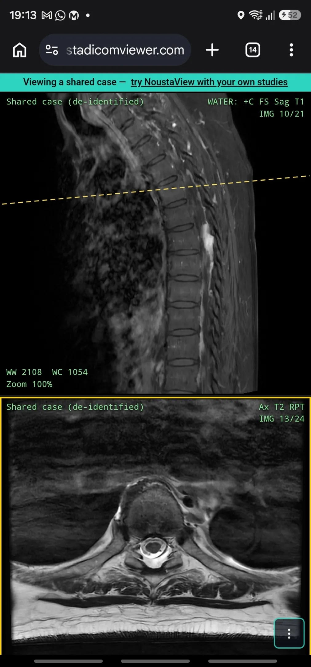 NoustaView on a phone with the toolbar hidden, showing just the shared MRI images edge to edge