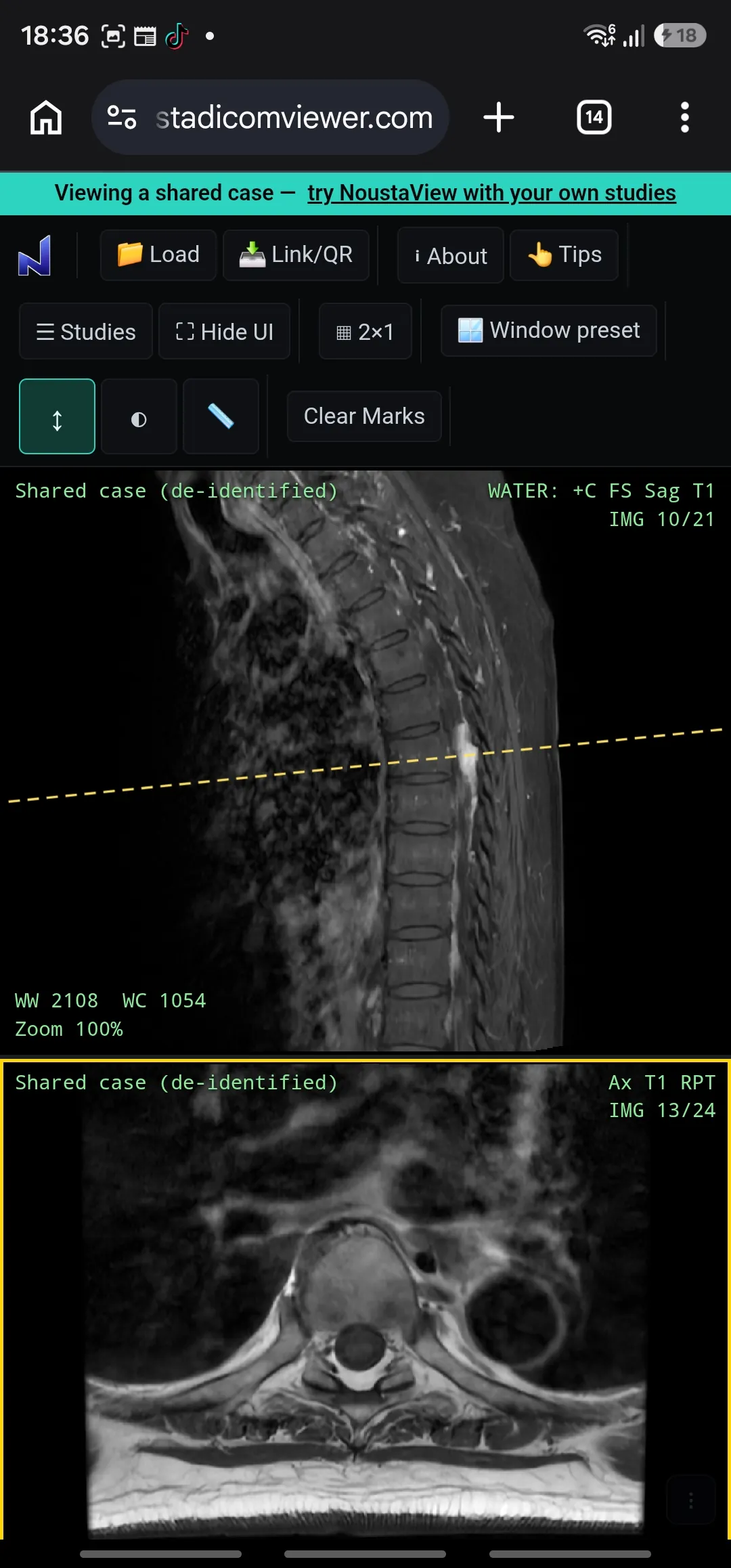 NoustaView on a phone, showing a shared spine MRI case with a length measurement tool active