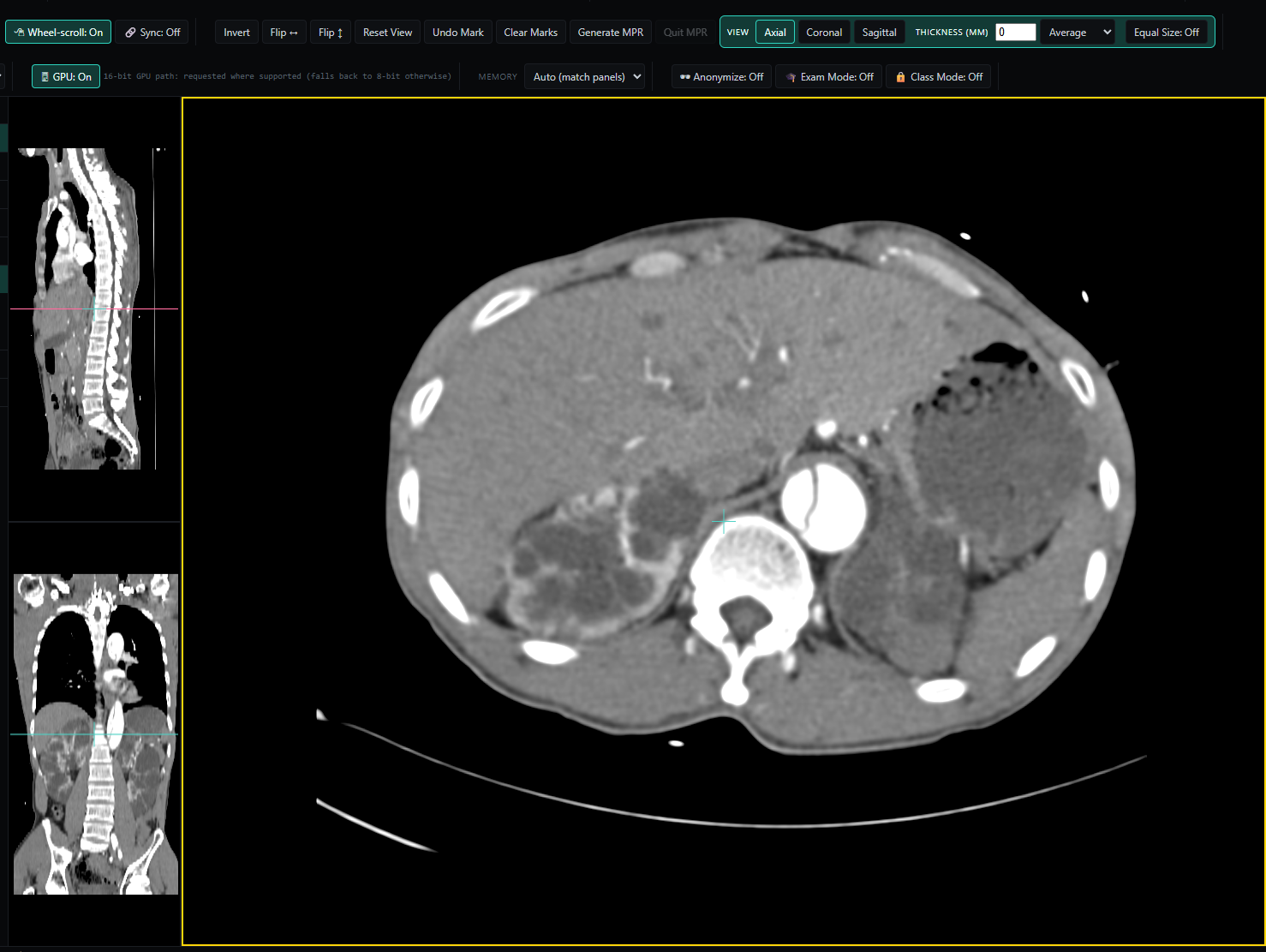 NoustaView showing a CT abdomen study in multiplanar reconstruction, with axial, sagittal, and coronal panels and GPU rendering enabled