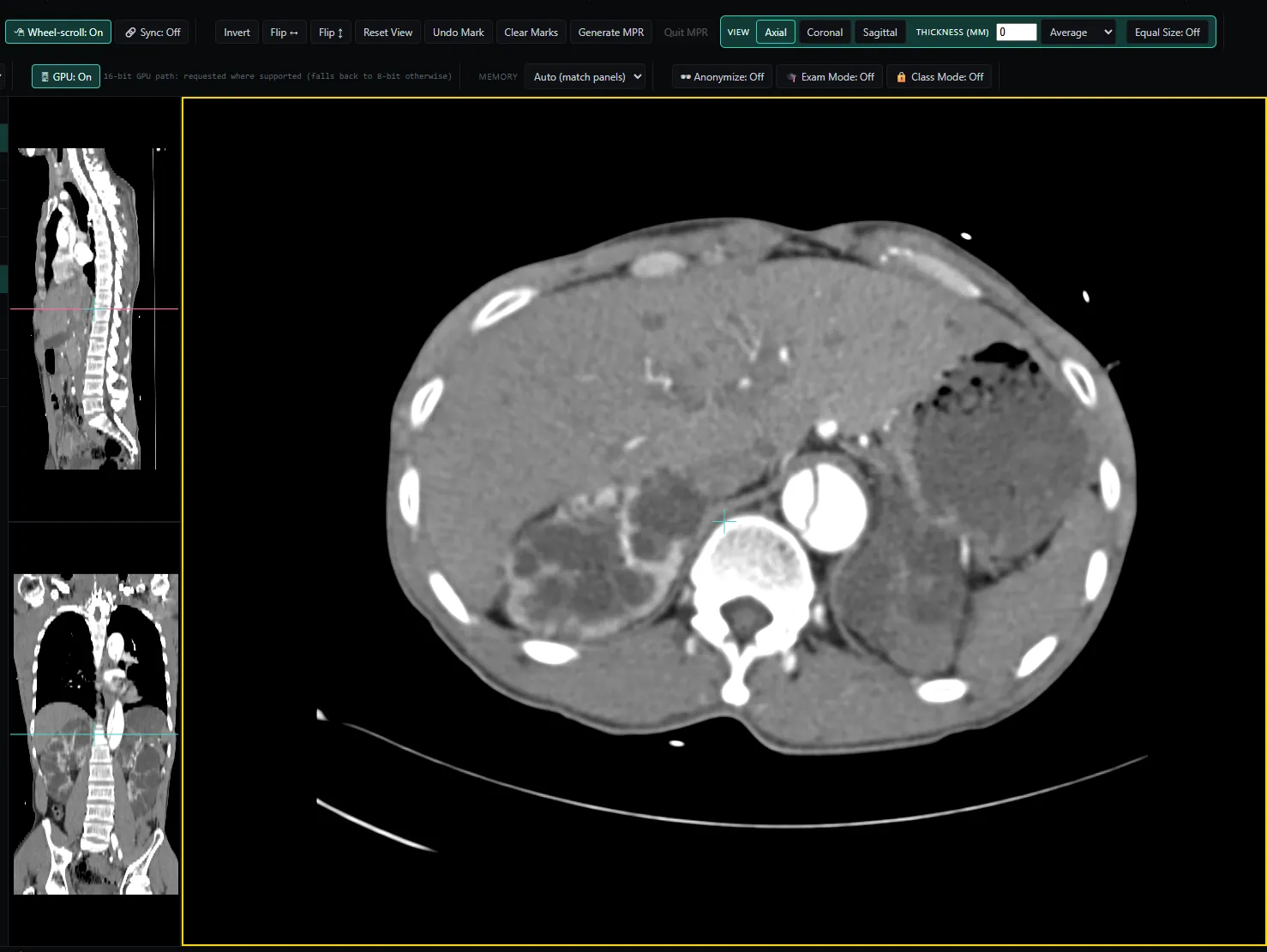 NoustaView showing a CT abdomen study in multiplanar reconstruction, with axial, sagittal, and coronal panels and GPU rendering enabled