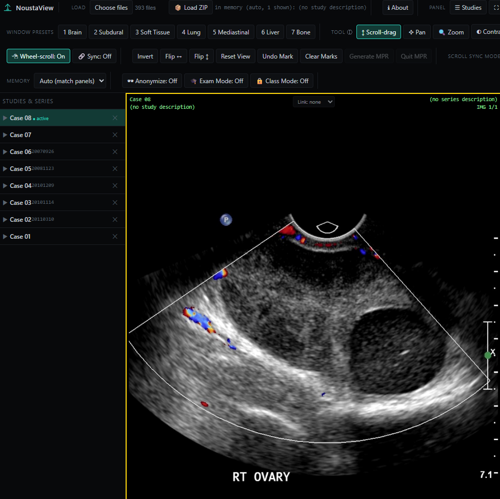 NoustaView showing a Doppler ultrasound study of the right ovary with color flow, and a sidebar listing eight loaded teaching cases